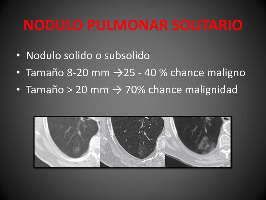 que es un nodulo pulmonar subsolido